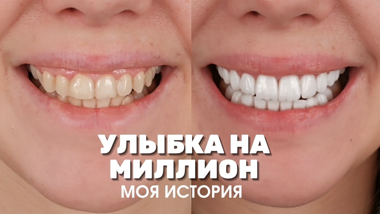 Виниры в Турции в 2 раза дешевле. Реальный отзыв о Myra Dental Clinic. Цены стоматологии Анталии.