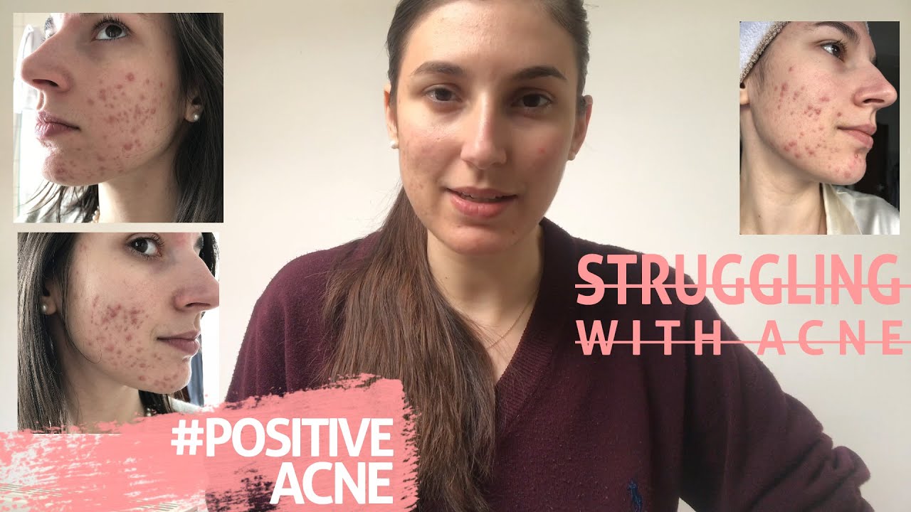 MY INTRODUCTION TO SKIN POSITIVITY!