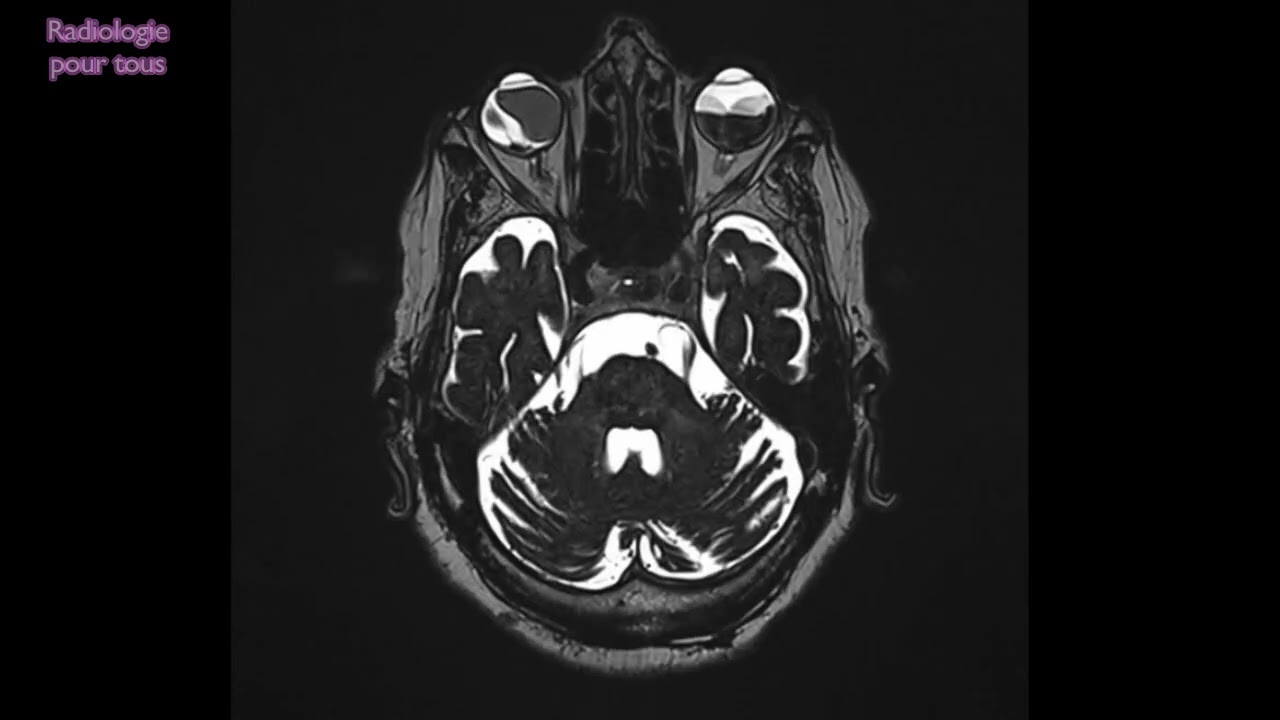 IRM ORBITO-CEREBRALE : DR. OG avec d&eacute;collement choro&iuml;dien &agrave; l&rsquo;&eacute;chographie. avec &eacute;paississement  .