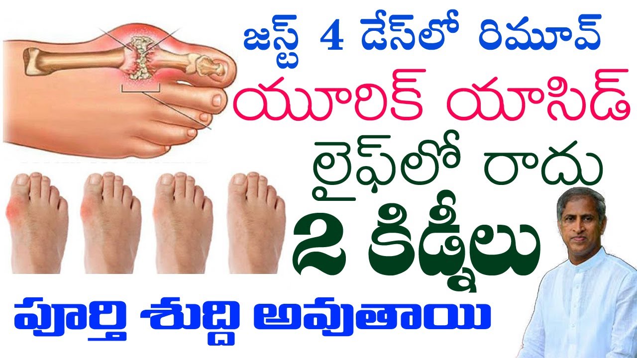 Uric Acid || జస్ట్ 4 డేస్ లో రిమూవ్ యూరిక్ యాసిడ్ లైఫ్ లో రాదు || Dr Manthena Satyanarayana Raju