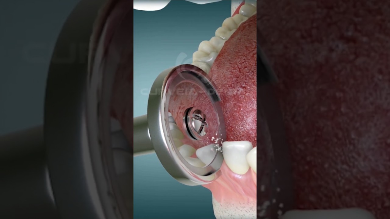 IPR Braces Orthodontic Treatment I CURVEIA  #shorts