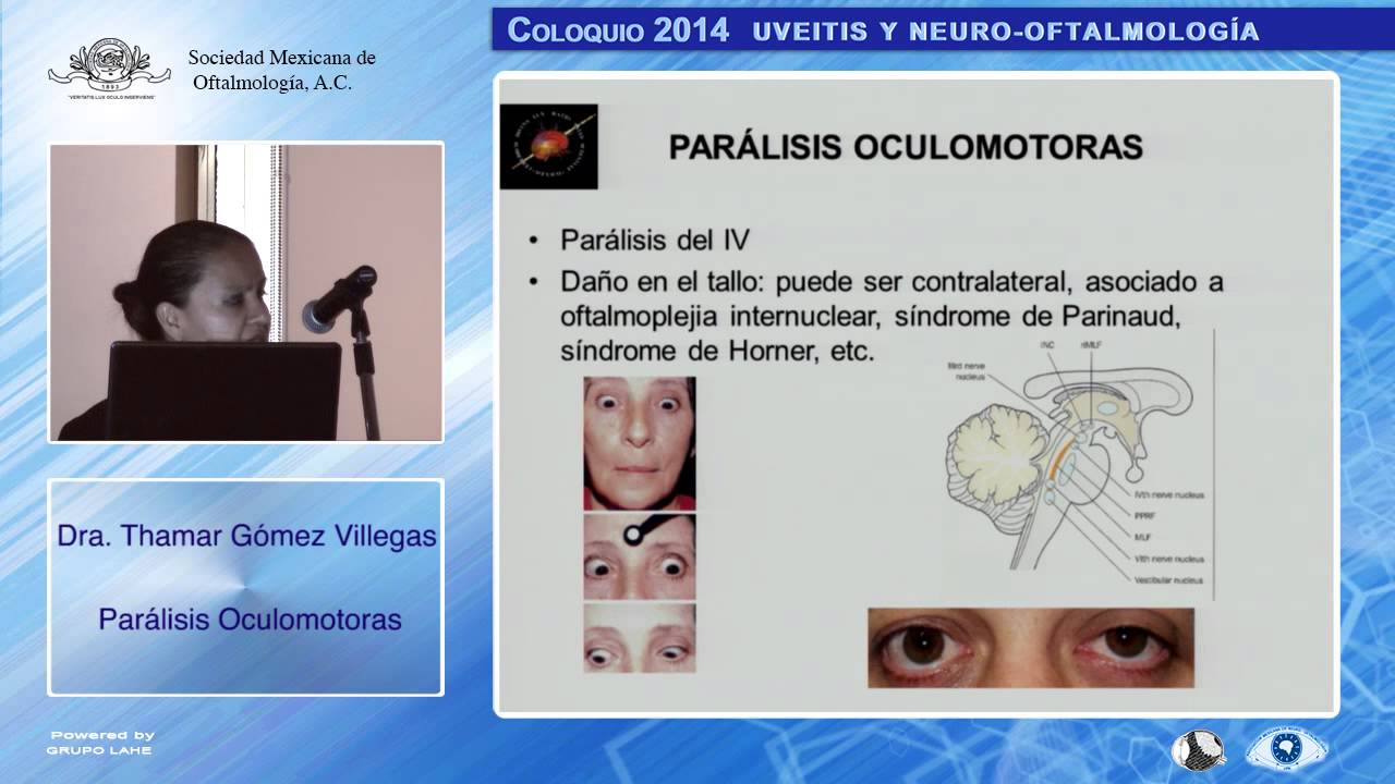 Dra. Thamar Gómez Villegas, Parálisis Oculomotoras - 14/11/2014