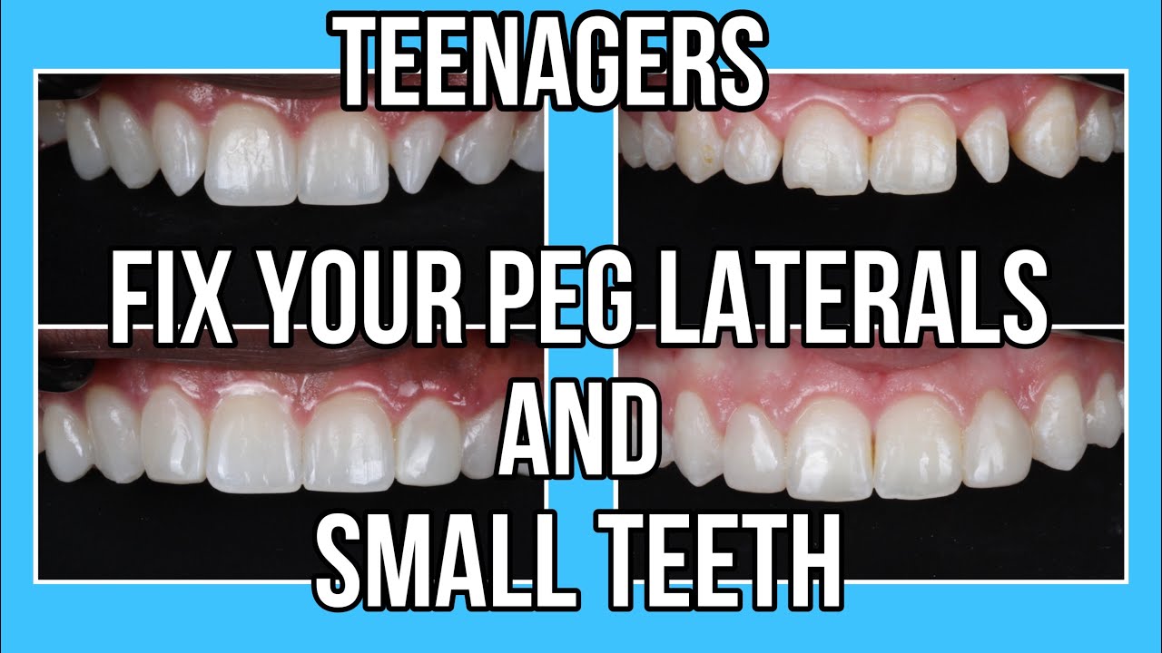 Teenagers, Fix Your Peg Laterals and Small Teeth!