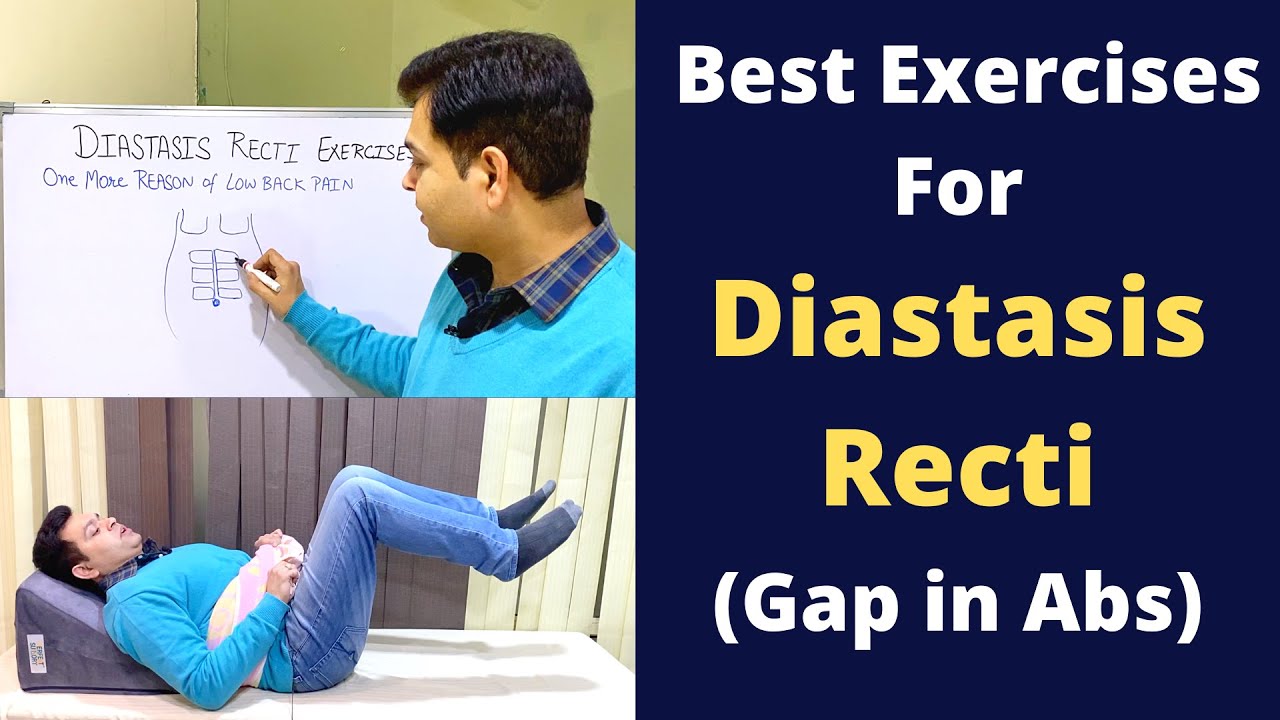 Exercises For Diastasis Recti, Abdominal Seperation, Diastasis Recti Treatment- Reason of Back Pain