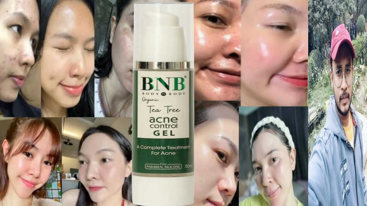 BNB Tea Tree Acne Control Gel | Honest Review