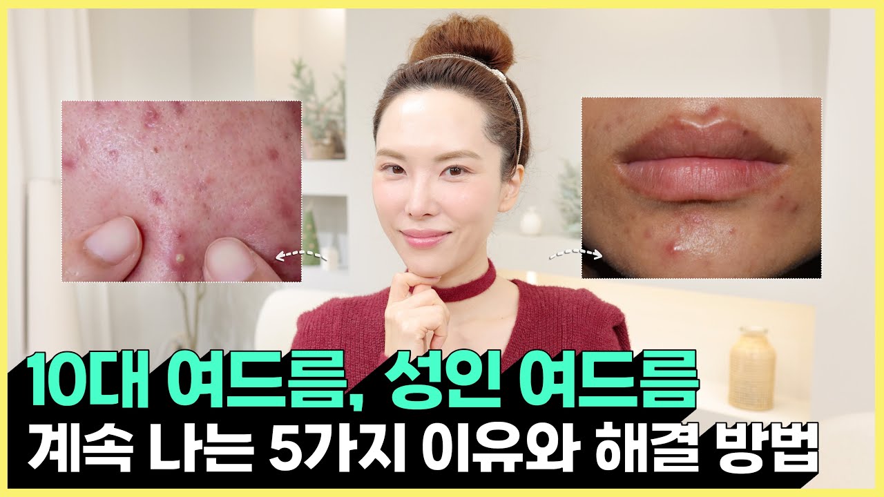 🔴 성인여드름 🔴 10대 여드름  없애는 약국템과 스킨케어루틴