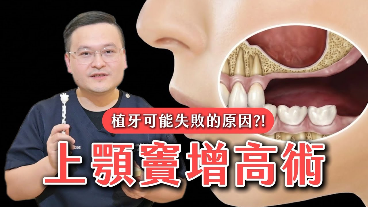 什麼是上顎竇增高術？手術模擬帶你快速看懂，打造植牙成功的關鍵基礎！