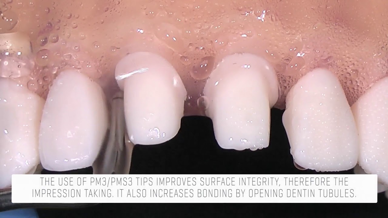 Newtron restorative ultrasonic tips