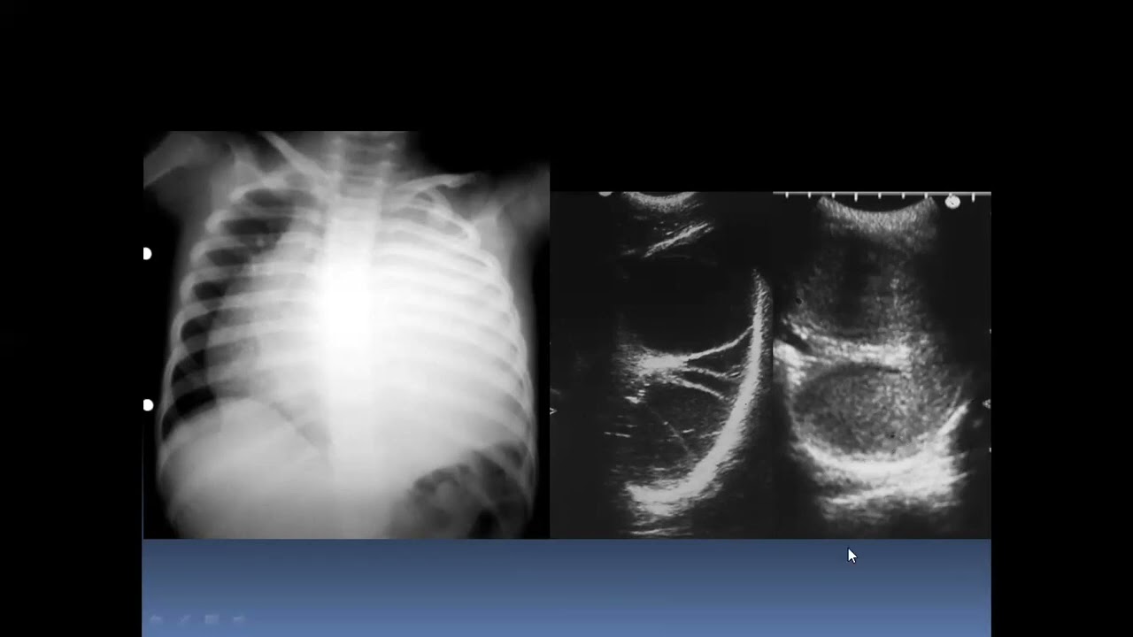 Diagnóstico por imágenes: Patología Pleural - Derrames, Neumotórax y Fibrotórax Explicados