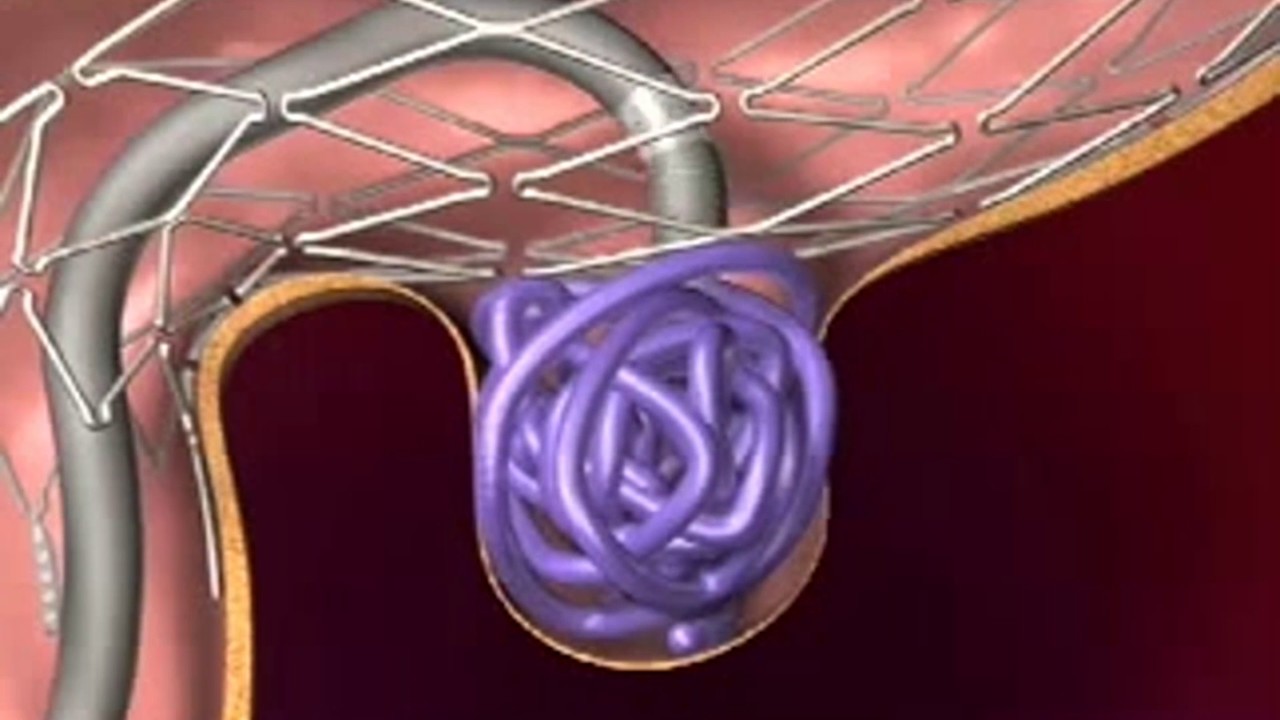 Stent yardımlı koil tedavisi
