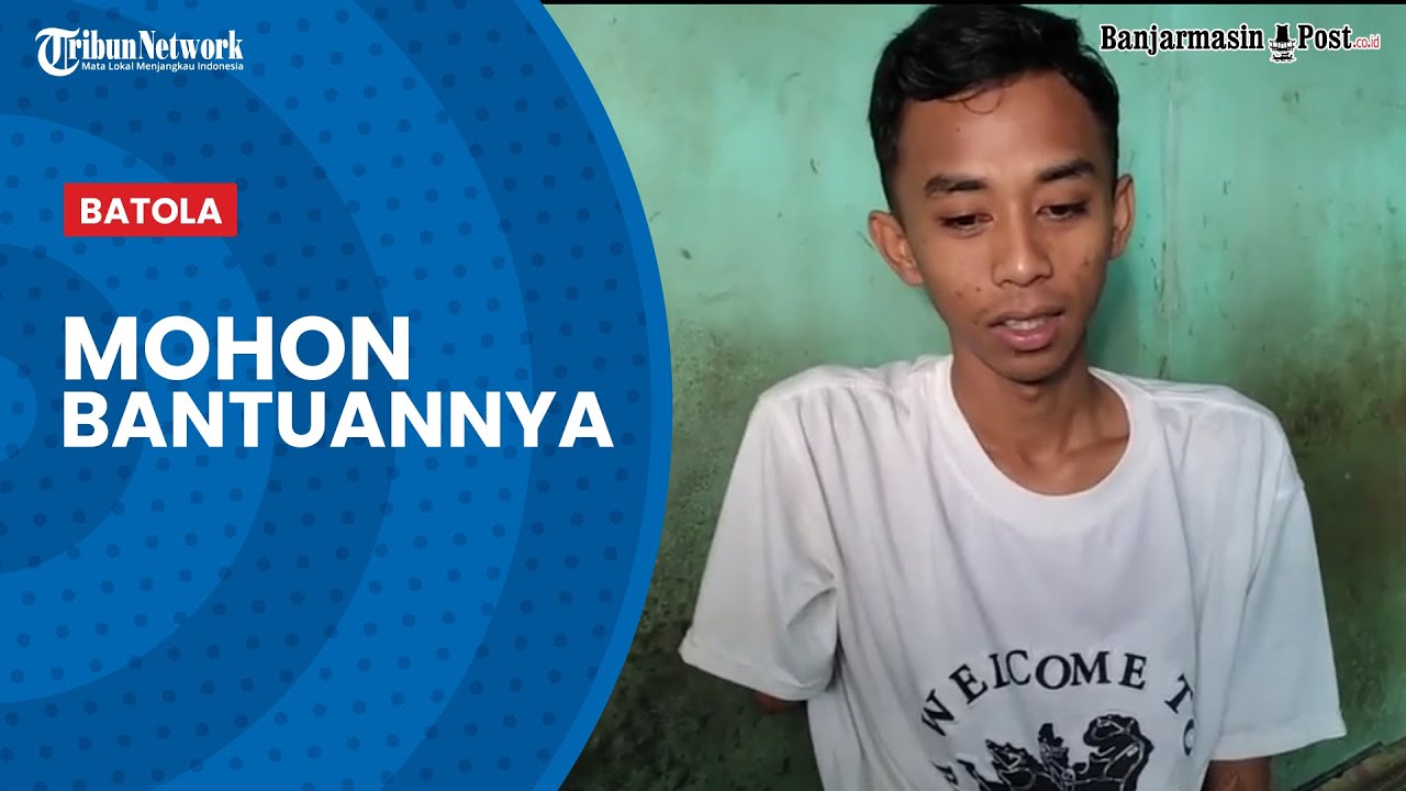 Mendengar Cerita Edi Susanto Korban Laka Kerja yang Kedua Tangannya Diamputasi