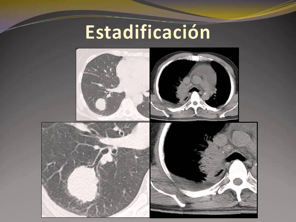 1 Cancer de pulmón Diagnostico y estadificacion Dr Costantino Sebastian