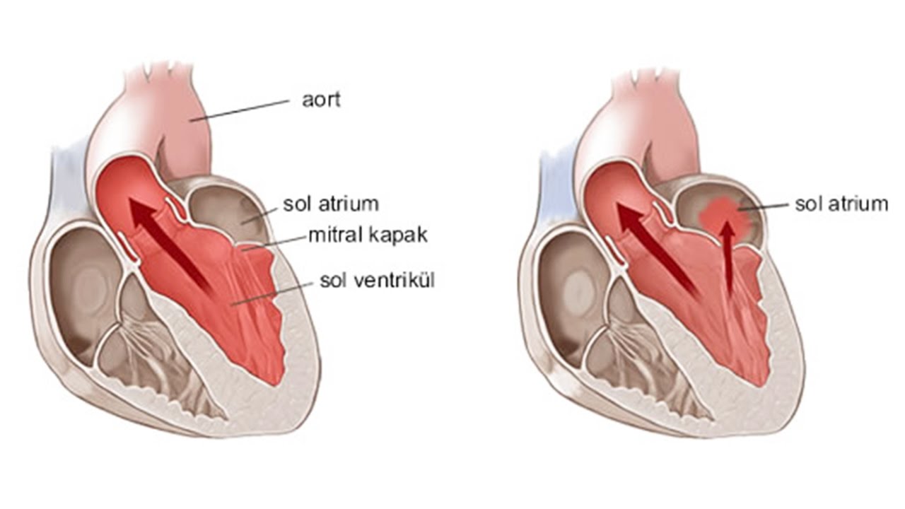 Mitral Kapak Proplapsusu Nedir ? -  Doç. Dr. Hüseyin Arınç - Dora Hospital