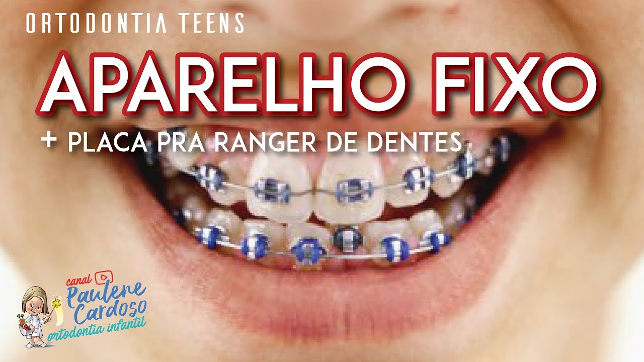 Dra Paulene Cardoso - Placa pra ranger de dentes + Aparelho fixo