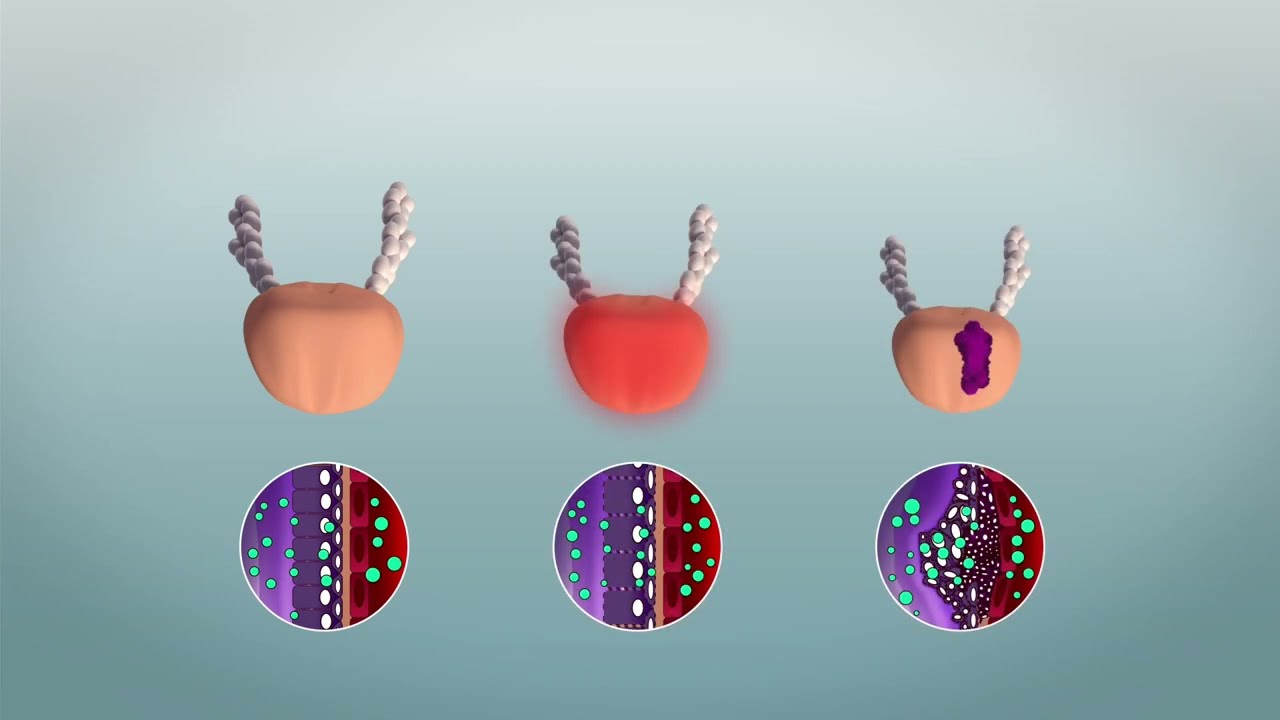 PSA Waarde en de prostaat