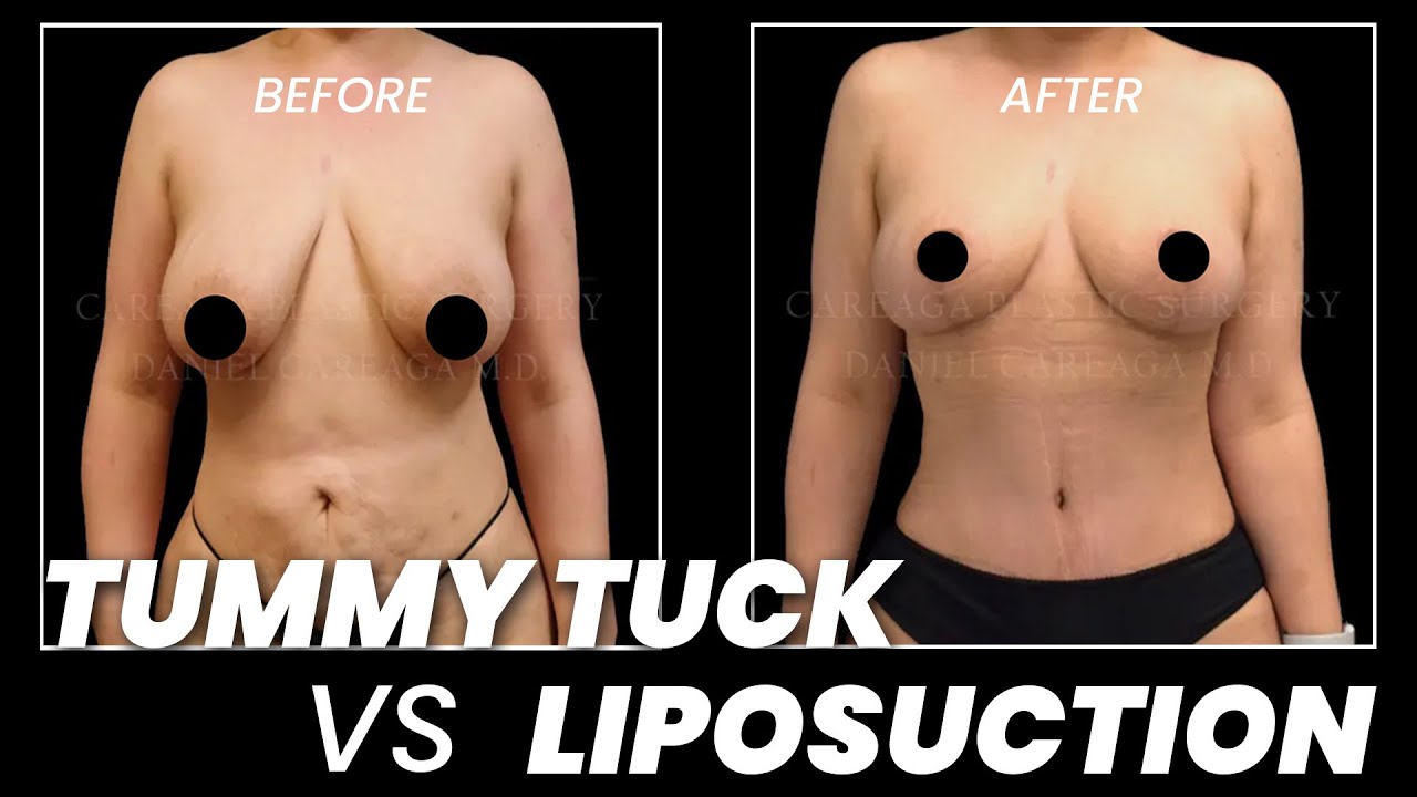 Liposuction vs Tummy Tuck: Choosing the Best Procedure for You