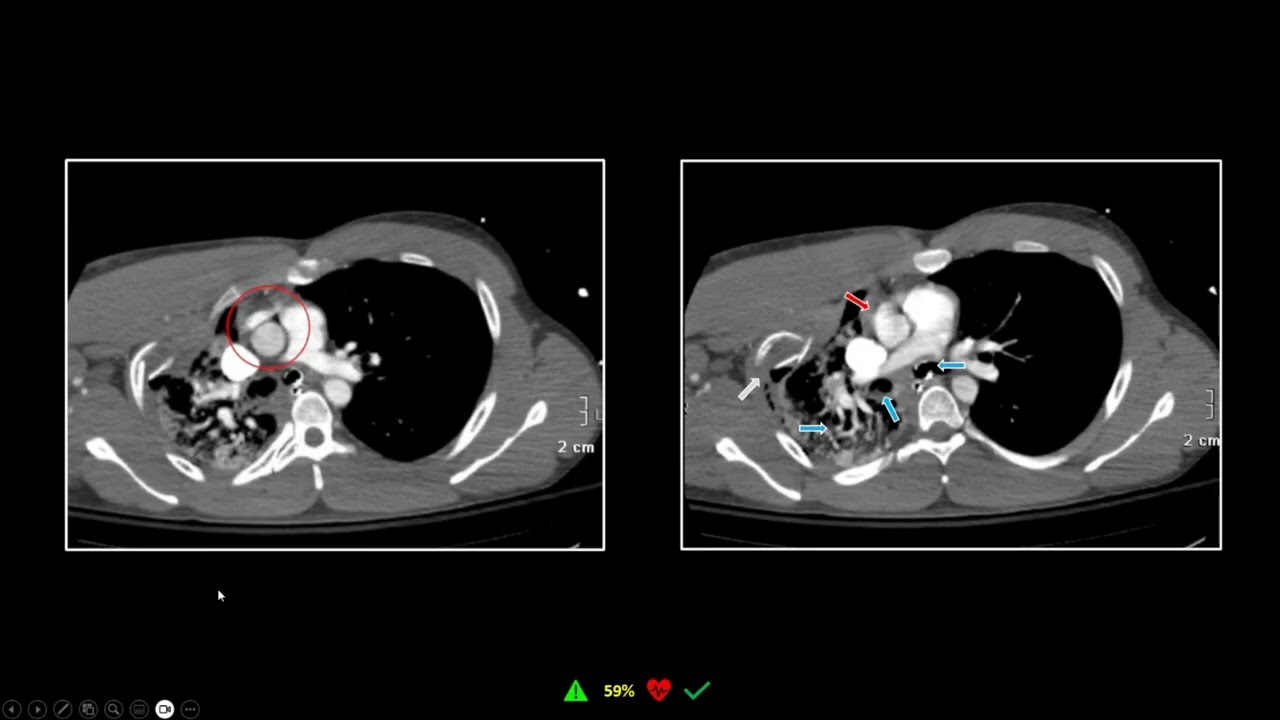 Компьютерная томография грудной клетки, часть 2 (аорта) | Бесплатное повышение квалификации в обл...