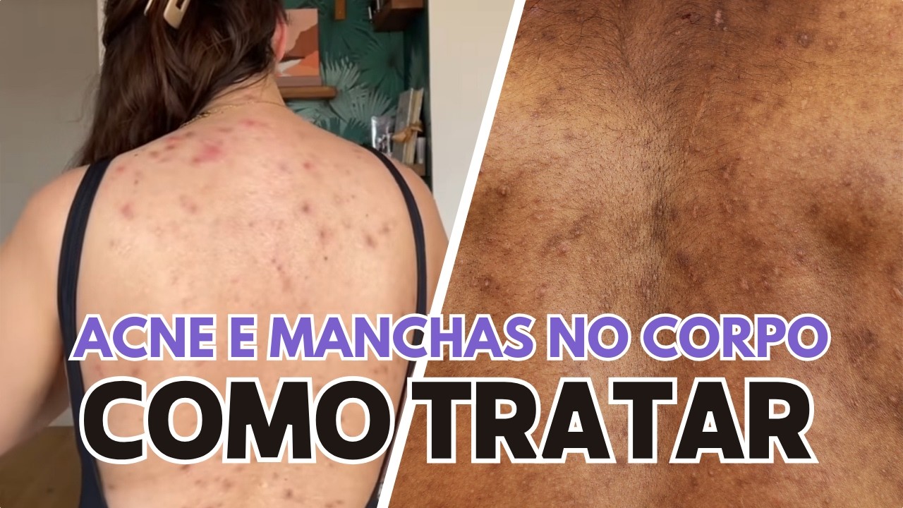 Guia Completo de como tratar Acne e Manchas nas Costas! | ACNE CORPORAL