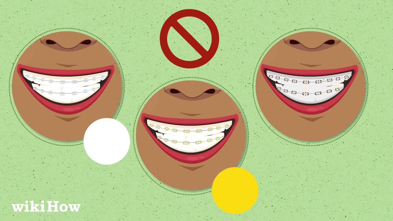 How to Choose the Best Braces Colors