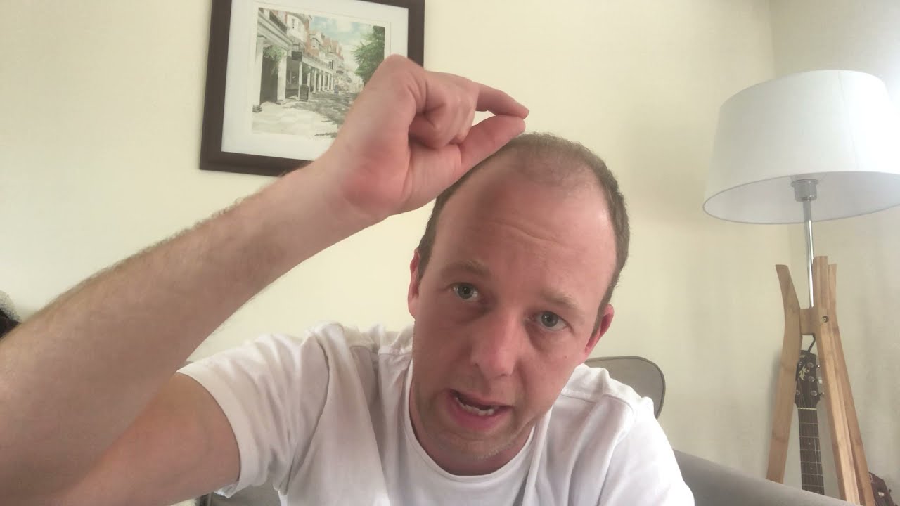 2.5 Month: Video Diary. 2000 FUE with Dr Ball Maitland Clinic UK