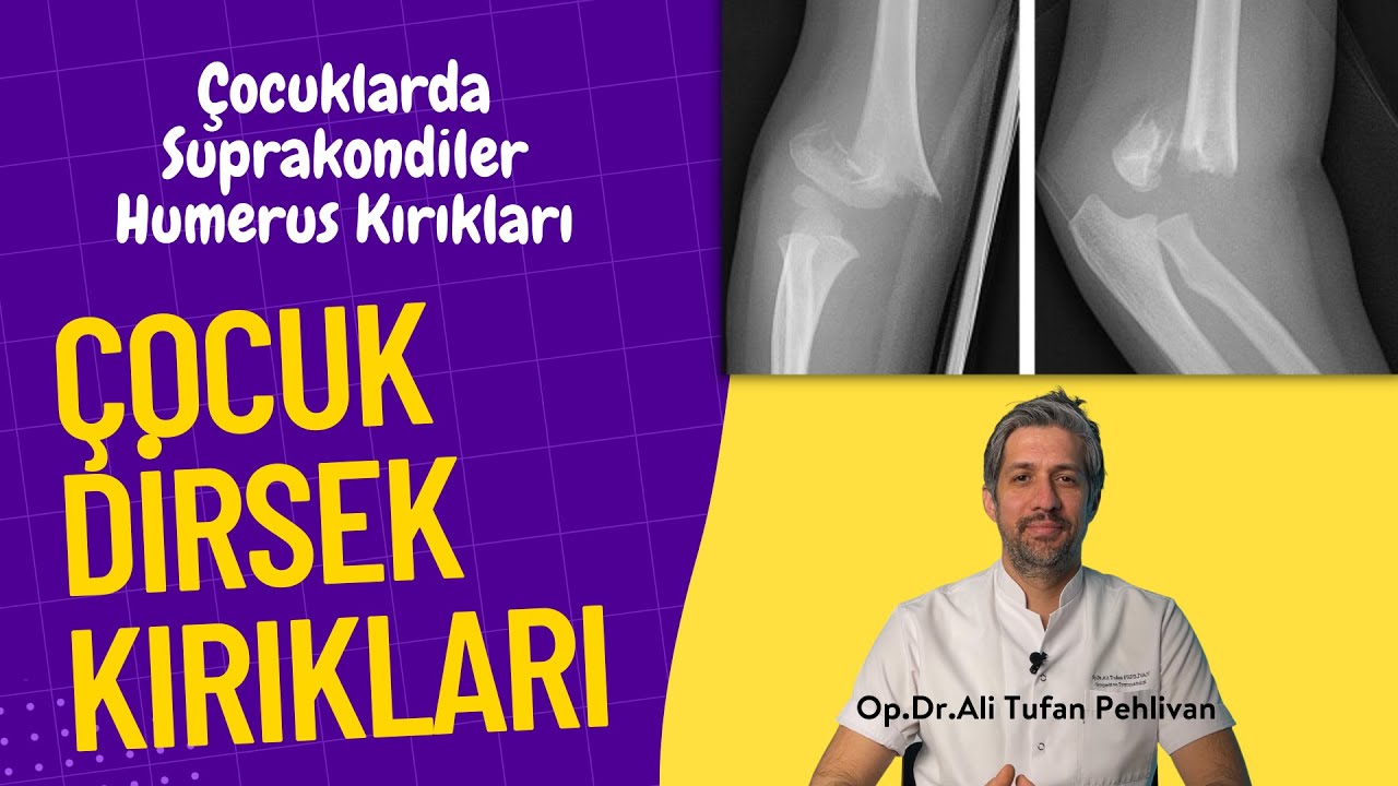 Çocuklarda Dirsek Kırığı( Suprakondiler Humerus Kırığı)