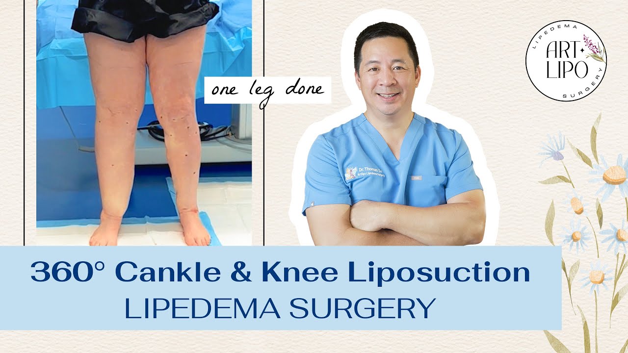 360&deg; Cankle & Knee Liposuction | Lipedema Surgery | Expert Dr. Thomas Su | Artlipo