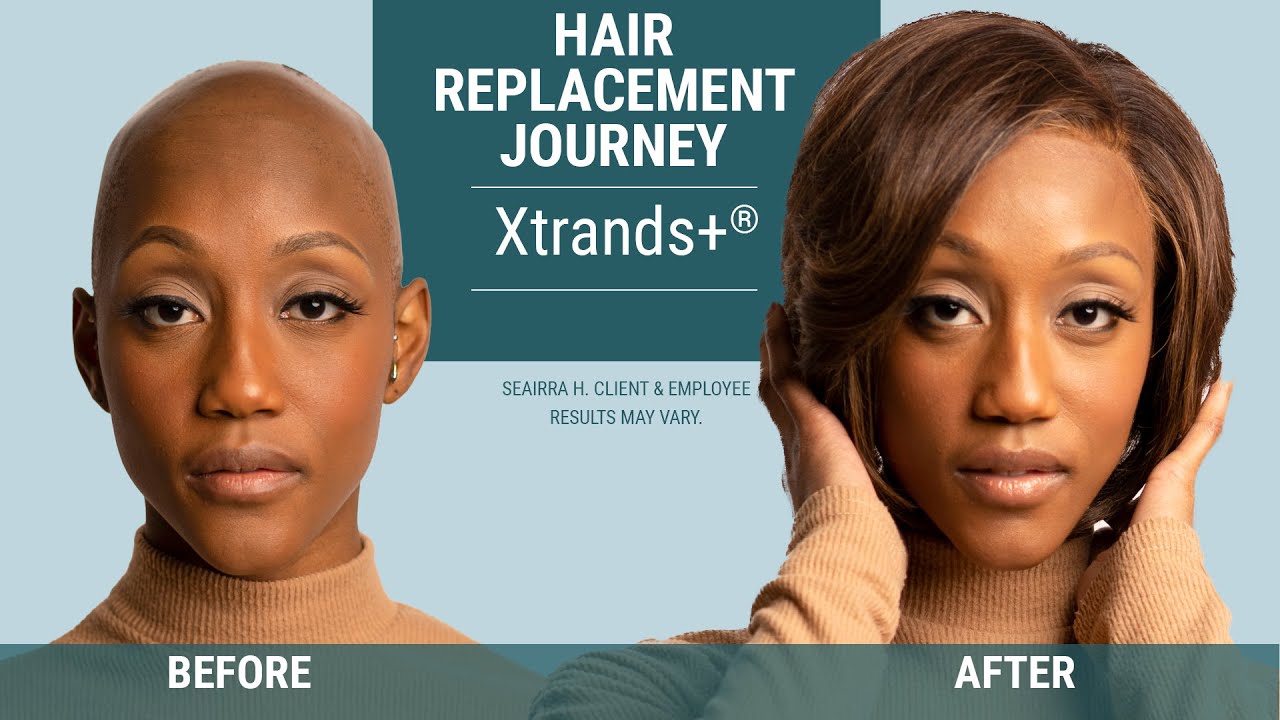 From Alopecia to Xtrands+ | Hair Replacement Journey