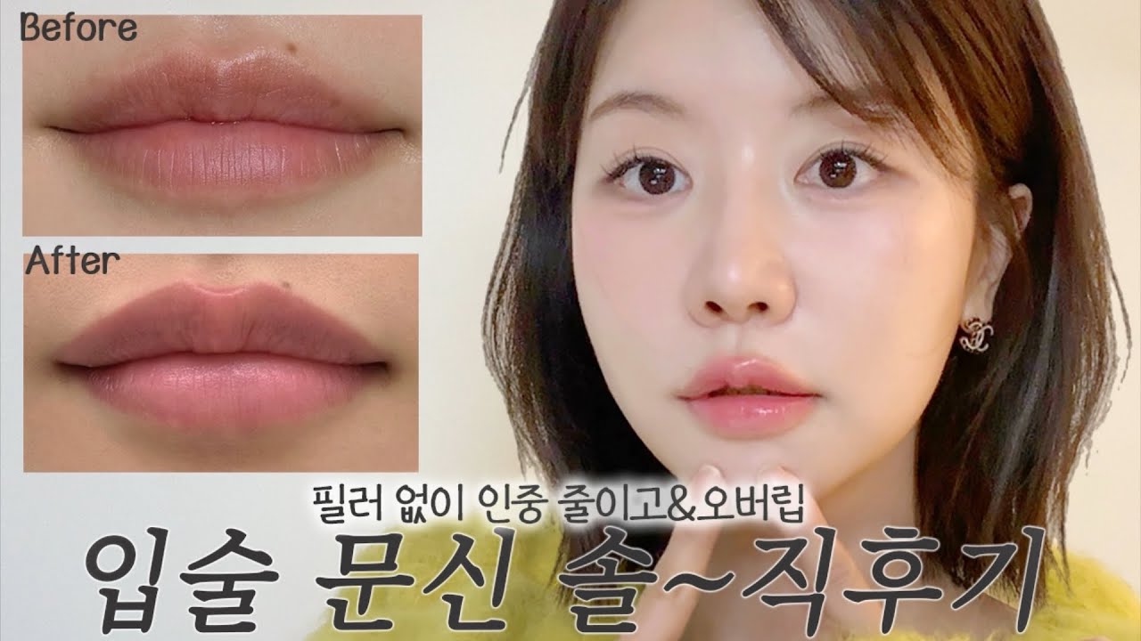 요즘 핫한 입술 타투 솔~직 후기💋자연스럽게 인중이 짧아지네..? 탈각 과정부터 통증, 장단점 다 담은 오버립 반영구 브이로그!
