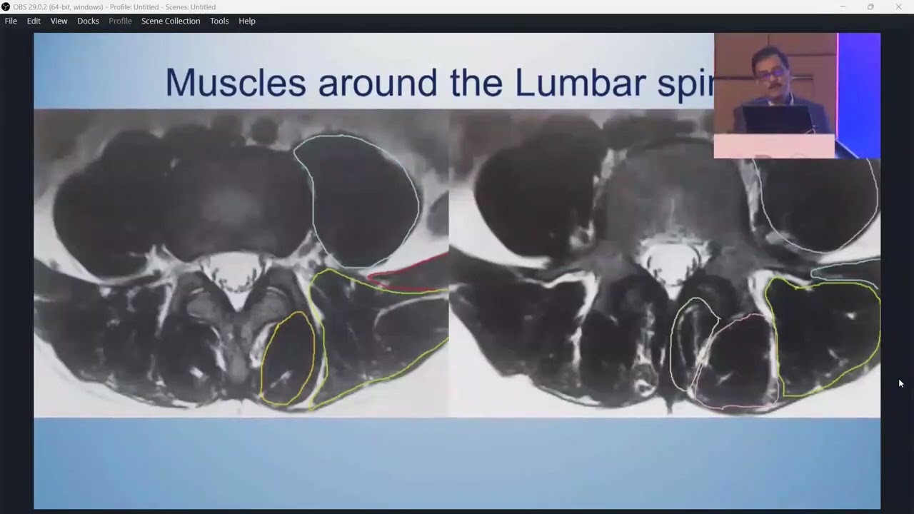 Ultrasound scanning of Lumbar Spine | USG of Disc | USG of Facet | Presidential Oration at ICMUPAIN