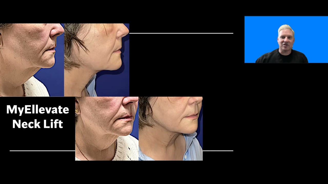 MyEllevate suture Necklift with Dr. John Burroughs at Springs Aesthetics, in Colorado Springs