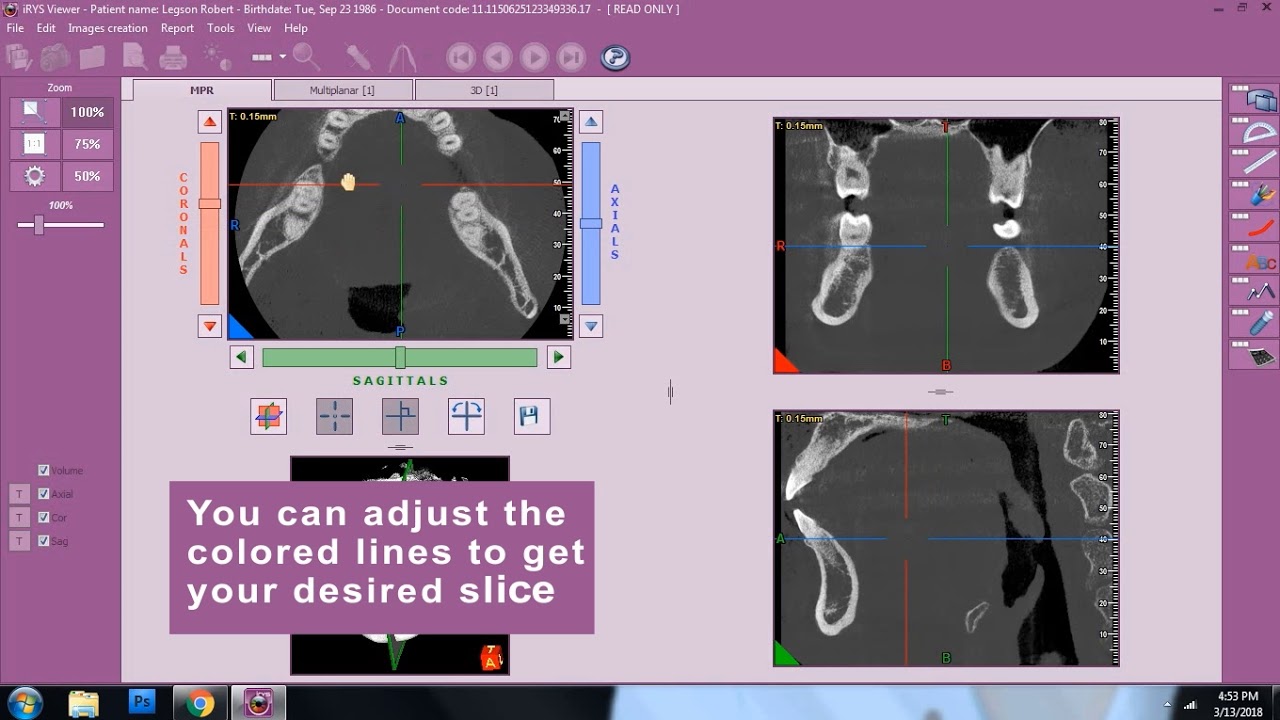 Insights Diagnostic - iRys Software Tutorial Video - Viewing MPR Tab