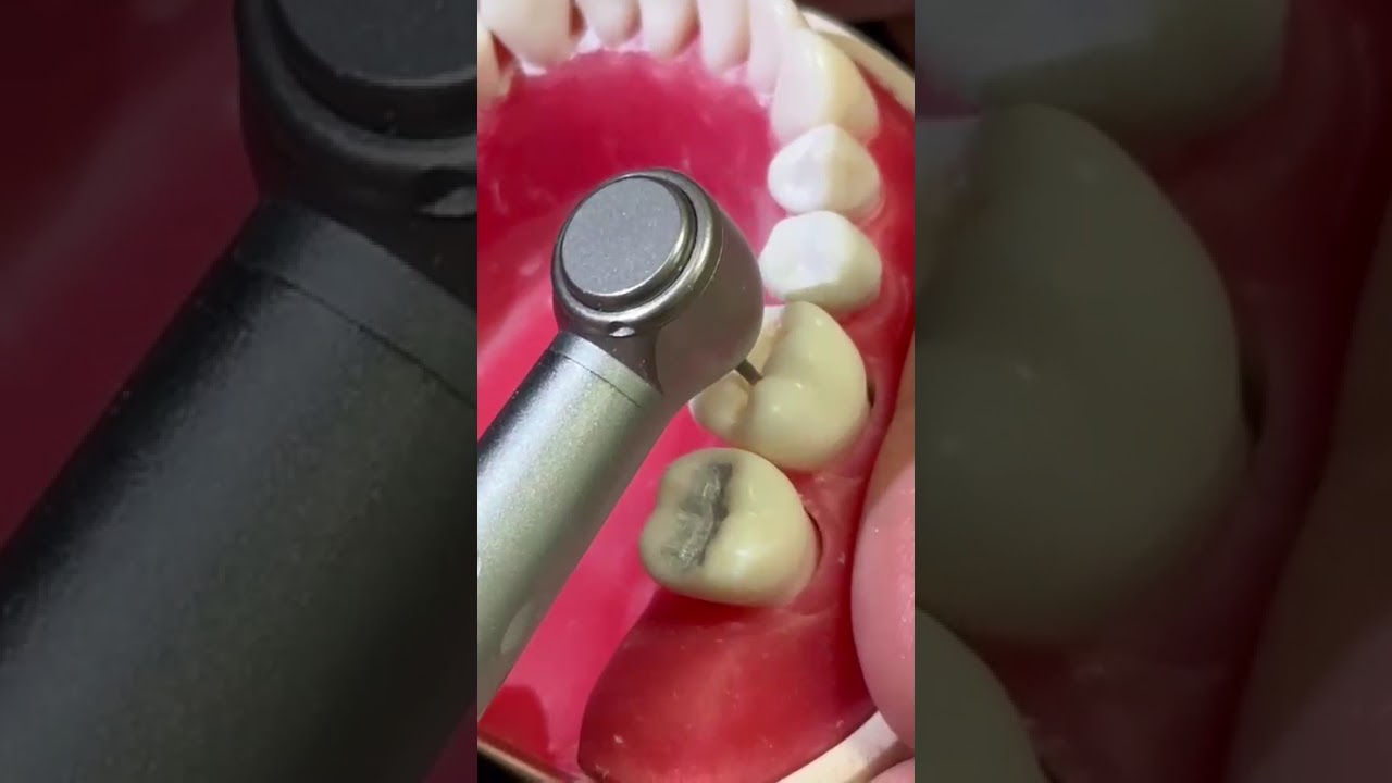 Class 1 cavity preparation technology operative 1