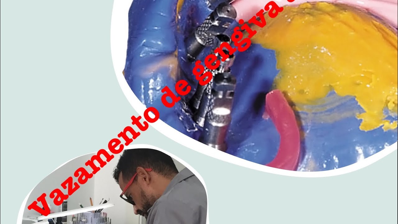 Dica- Vazamento de gengiva Artificial para modelos de implante