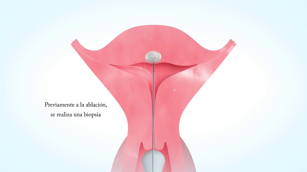 Radiofrecuencia como alternativa mínimamente invasiva para el tratamiento de miomas uterinos