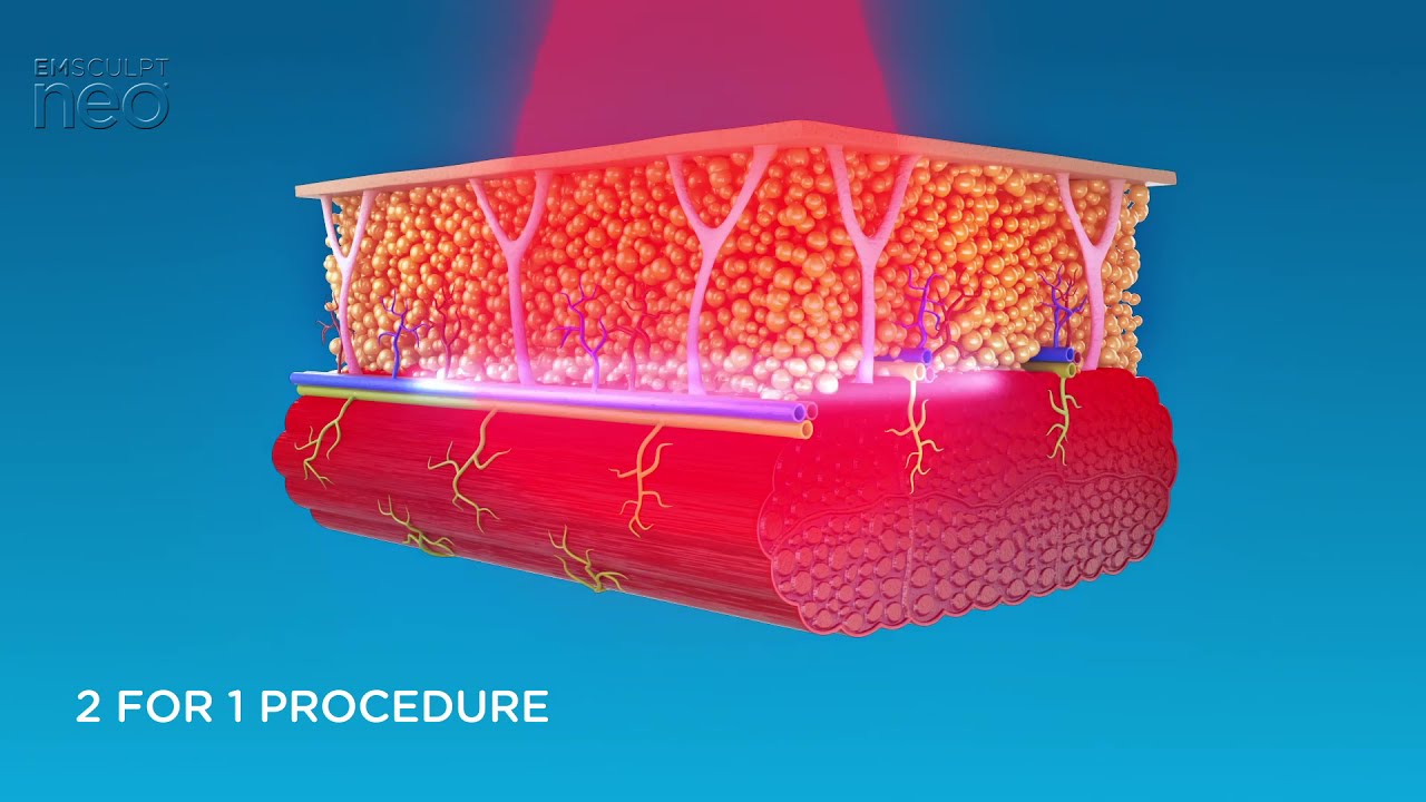 EMSCULPT NEO - Desarrollo muscular (HIFEM) y reducción de grasa (Radiofrecuencia (RF).