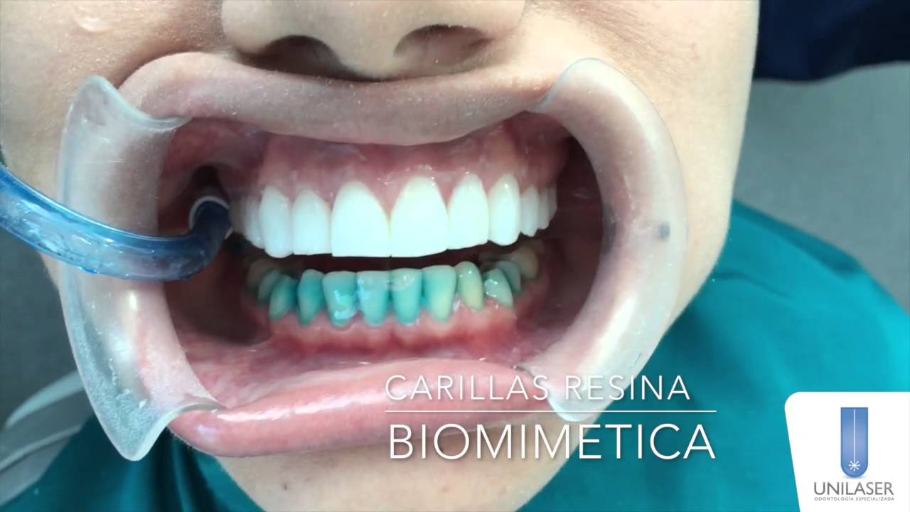 Unilaser | Dise&ntilde;o de Sonrisa sobre dientes naturales