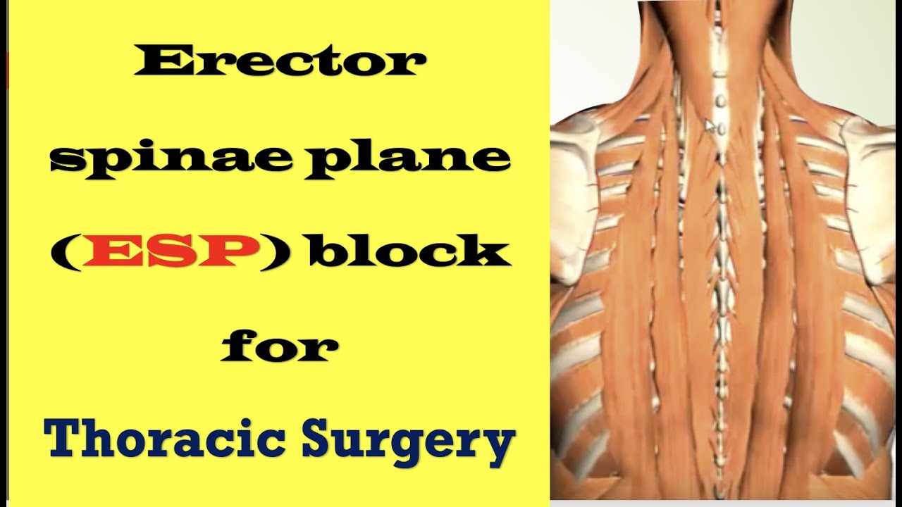 Erector spinae plane (ESP)  block for thoracic surgery