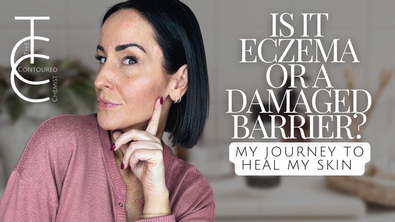 My Eczema Journey...