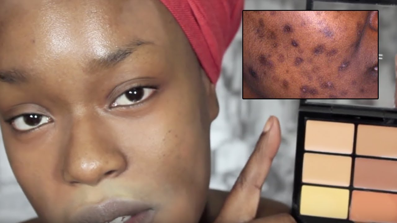 AMAZING SECRETS Cover ACNE scars DARK SKIN