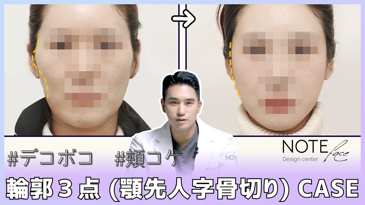 ⚠️頬骨縮小=面長ではありません！35歳 輪郭３点ケースレビュー📖｜韓国整形｜輪郭整形｜輪郭３点