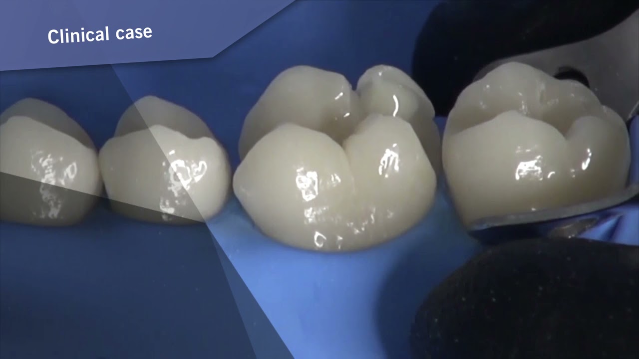 Restoration know-how by weakened cusps in vital teeth – Clinical case by Dr. Pezzana VisCalor bulk