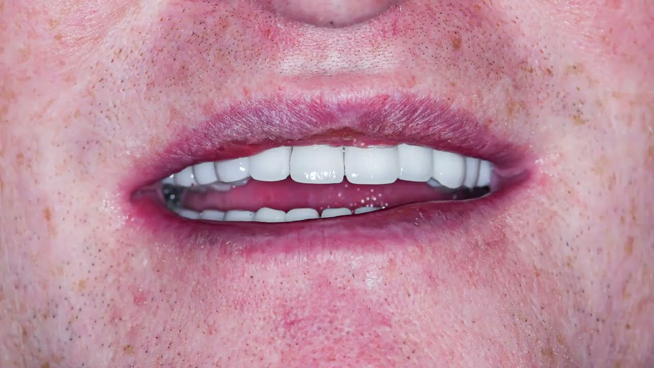 Dental Surgery | Dental Implants - A Closer Look | Tower Dental Clinic