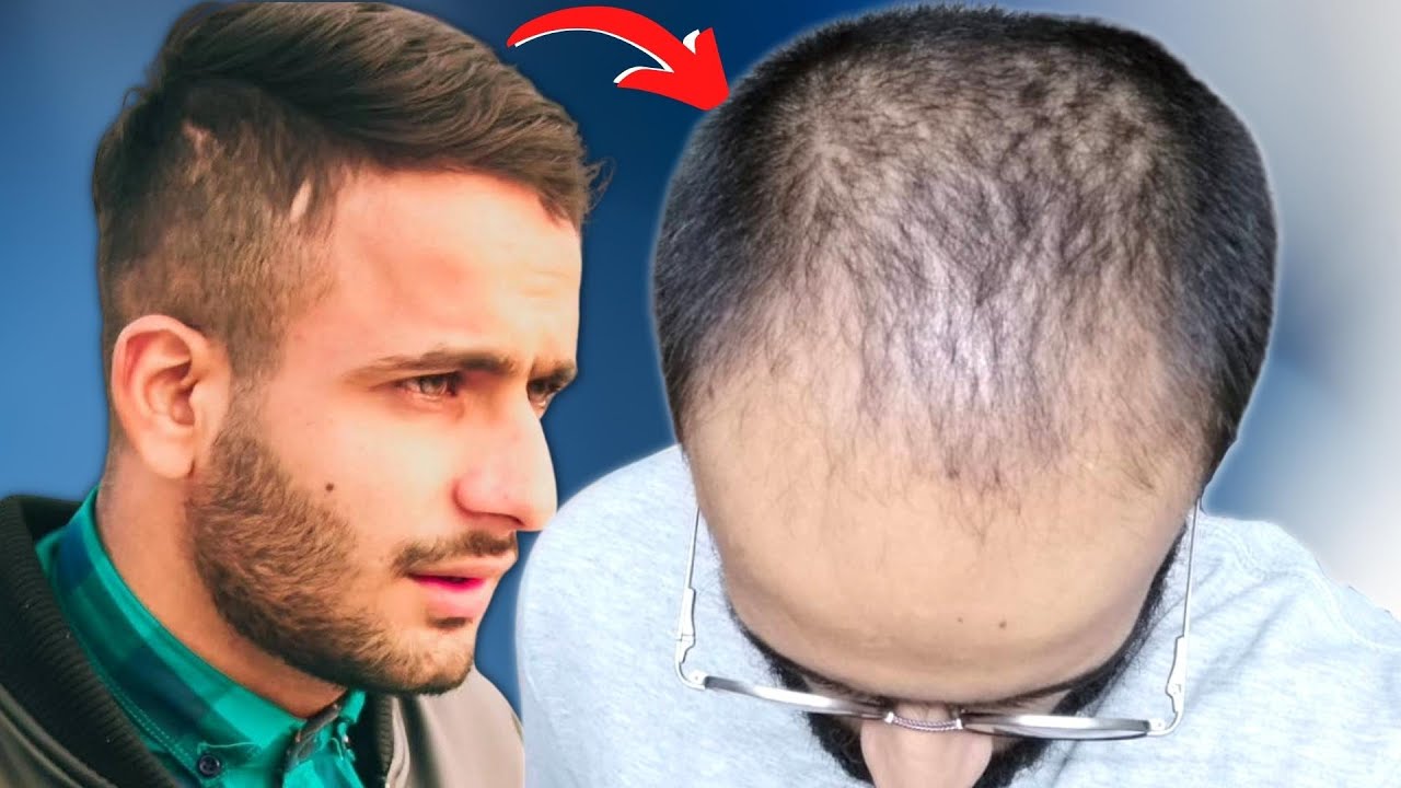 OVERCOMING BALDING INSECURITY *A Motivational Story*