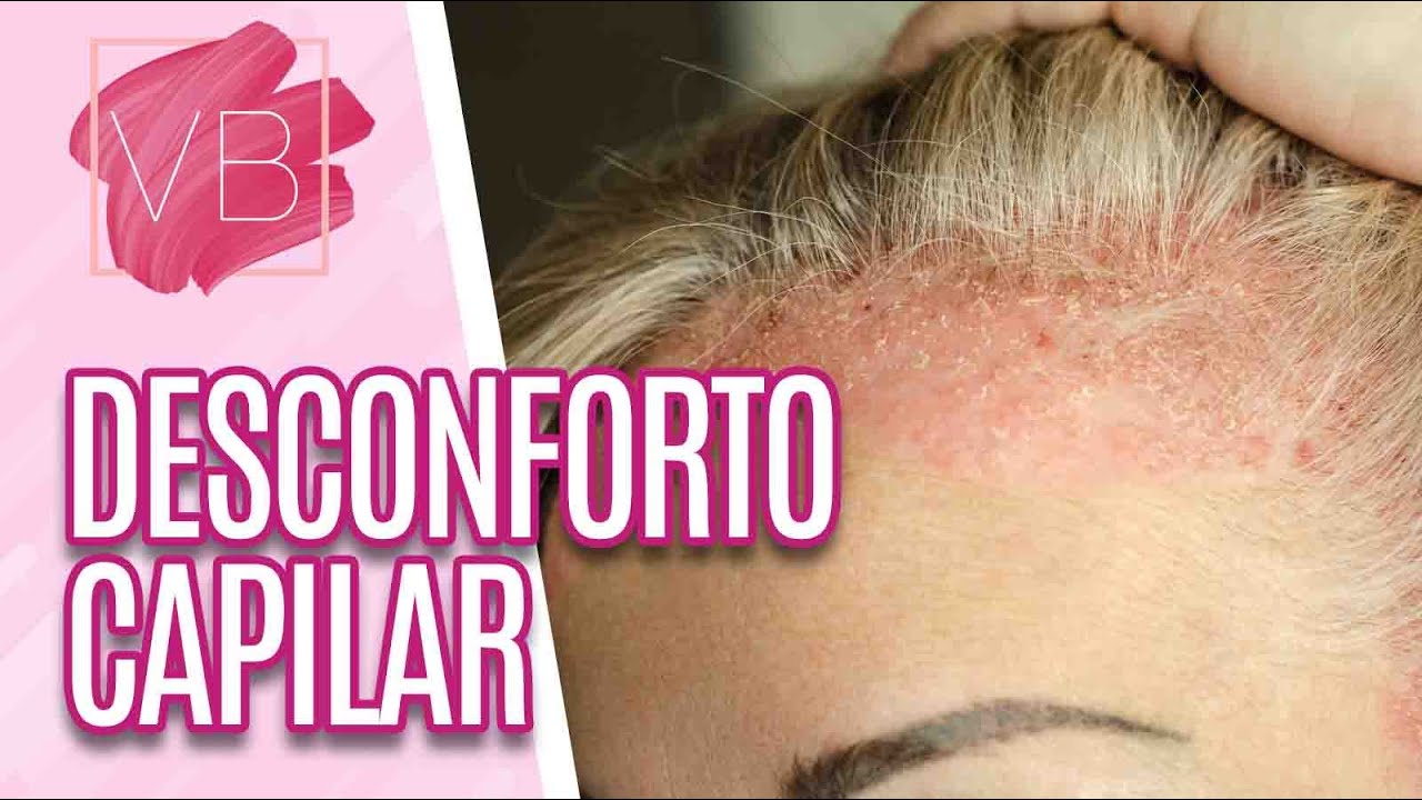 Desconforto Capilar: doenças no couro cabeludo - Você Bonita (31/05/21)