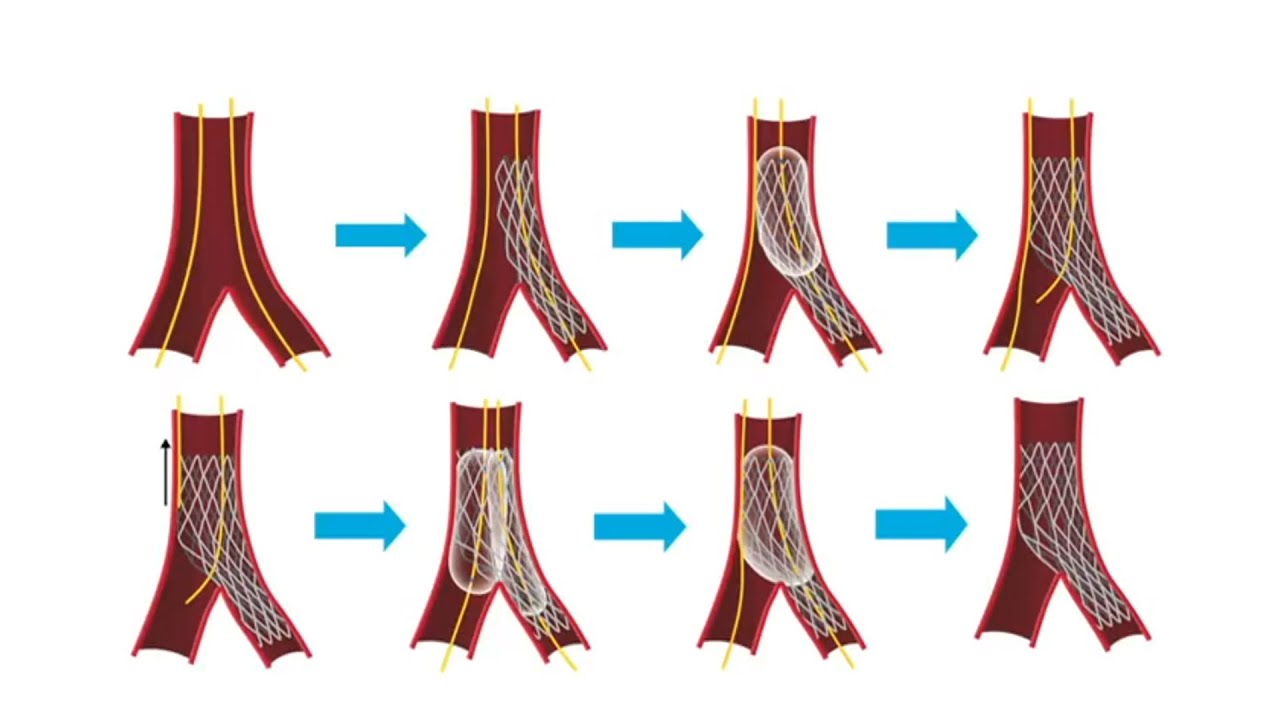 Case based step by step culotte technique in a bifurcation - Round Table Webinar