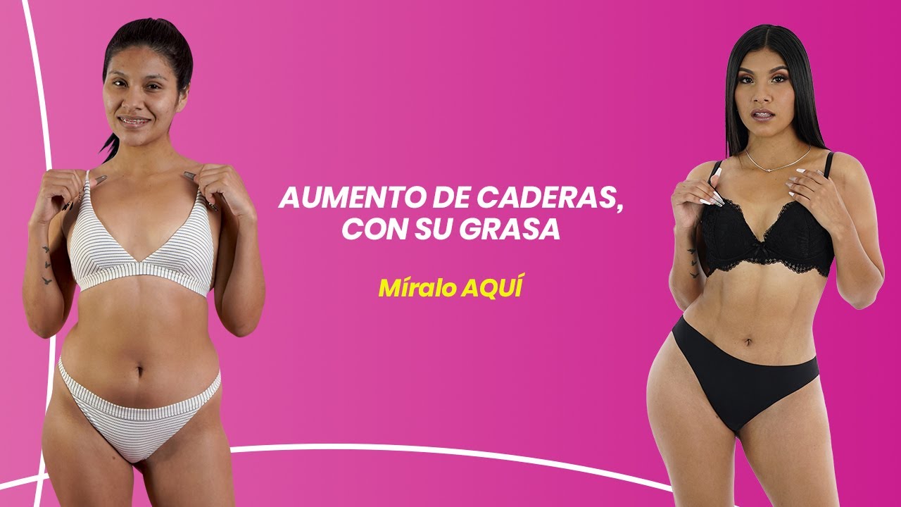 AUMENTO DE CADERAS CON SU GRASA, MÍRALO AQUÍ