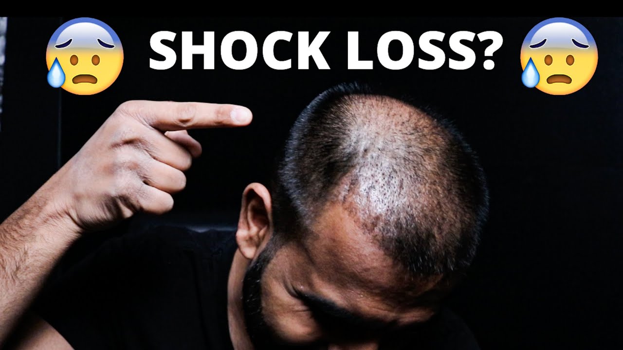 1 Month Turkey Hair Transplant Update | Shedding Phase