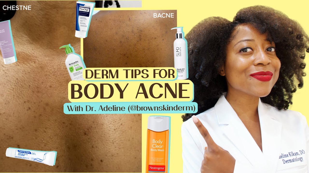 Body Acne Treatment | Get rid of Body Acne | Derm Guide for Body Acne and blemishes | Brownskinderm