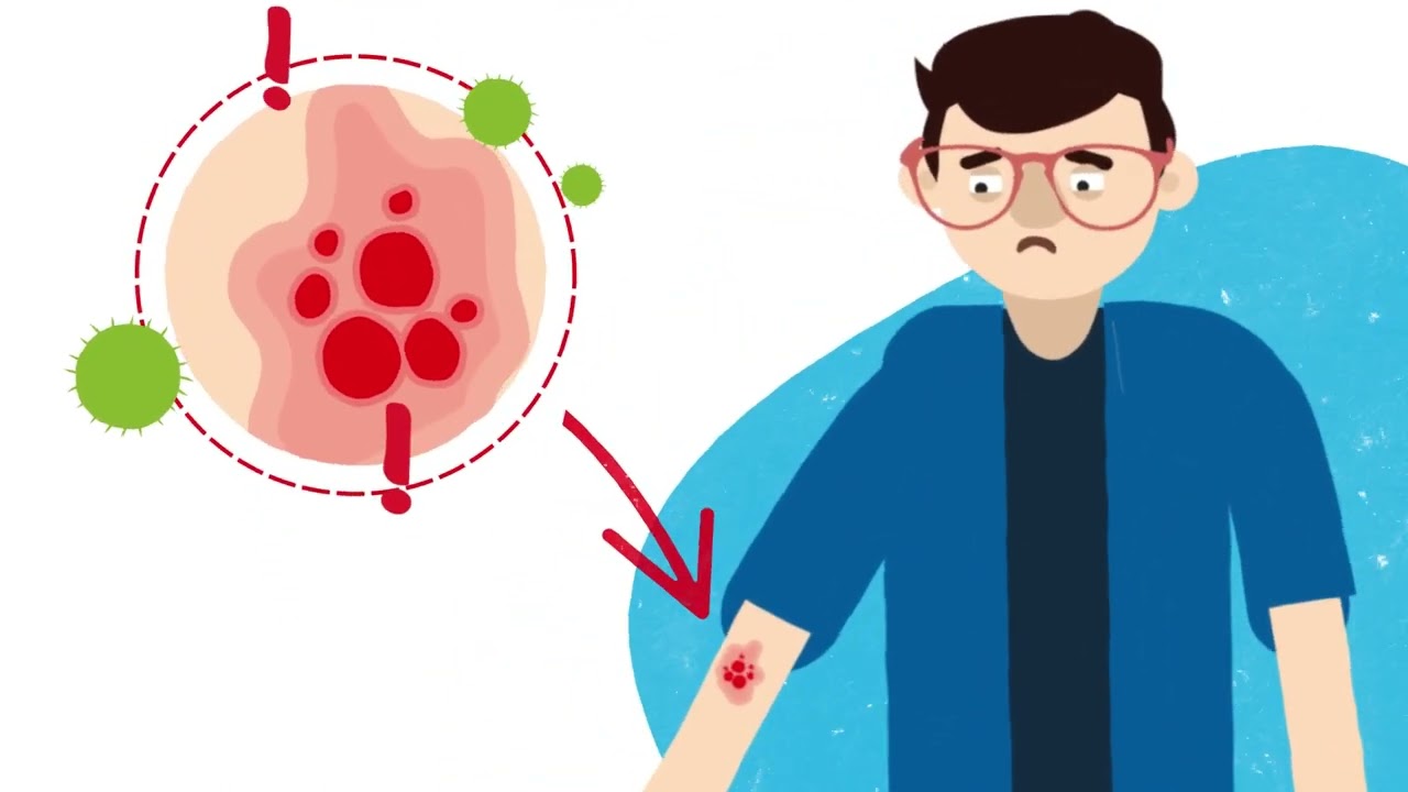 Biologicals and Treatments for Eczema