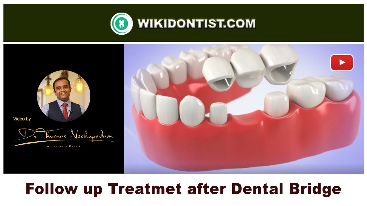 Follow up Treatment after Dental Bridge ... / Video by Dr.Thomas Nechupadam